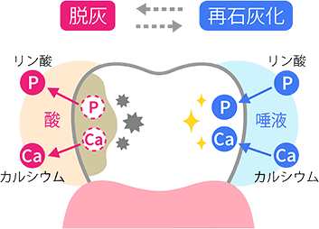 初期むし歯を修復します