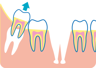 ドナー歯の抜歯