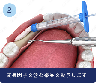 2 成長因子を含む薬品を投与します